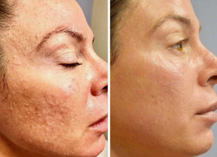 Before &After
